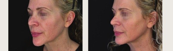 K-Luxe before and after — clinical example