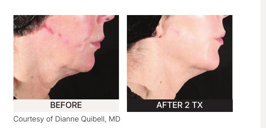 Xerf before and after — clinical example