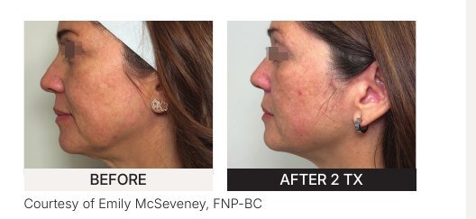 Xerf before and after — clinical example