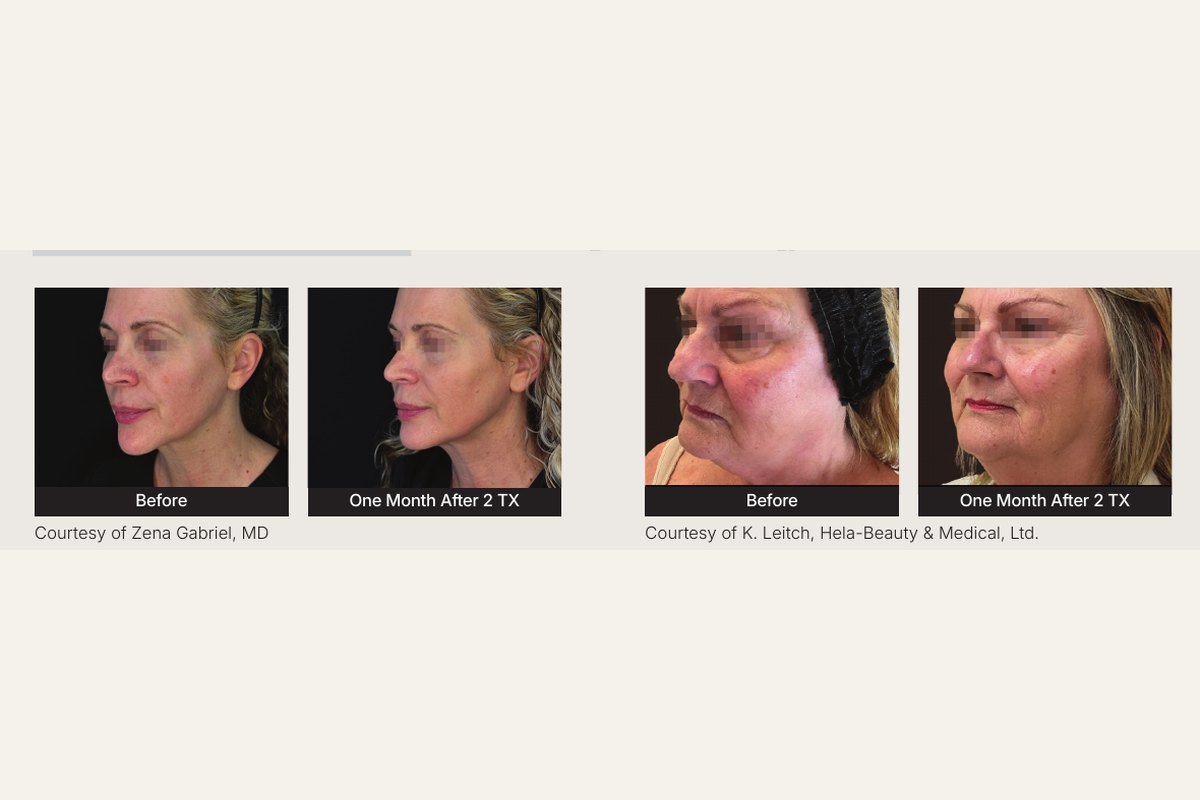K-Luxe before and after — Xerf tightening and Ultra brightening