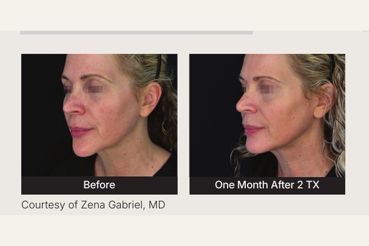 Energy treatment before and after — tone and texture