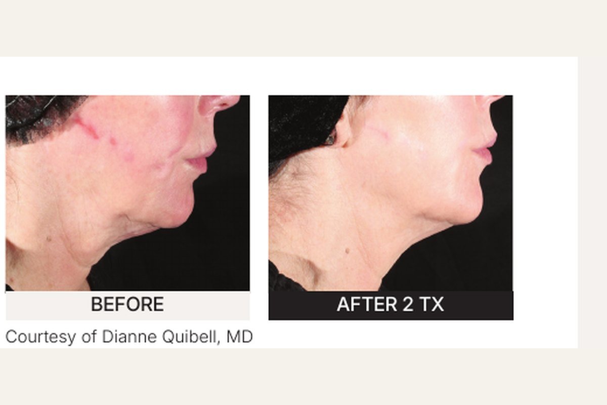 Xerf RF before and after — structural skin tightening