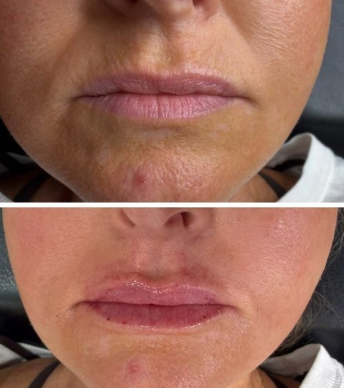 Before and after — lip filler, Satori patient