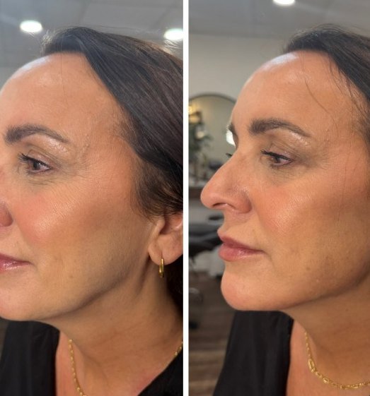 Before and after — Radiesse jawline and chin, Satori patient