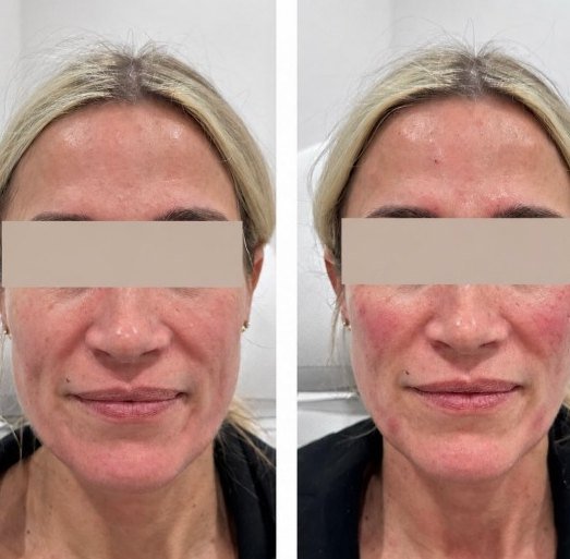 Before and after — Radiesse jawline and chin, Satori patient